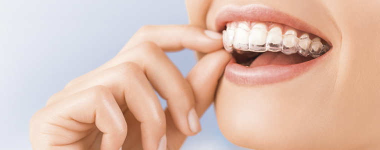 Gli allineatori Smilers