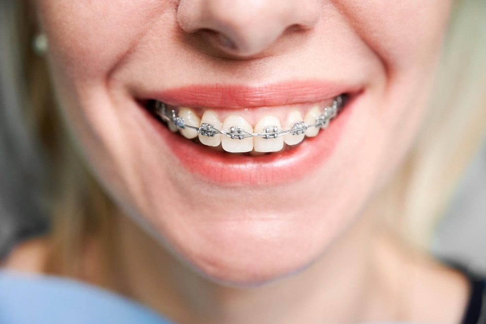 Apparecchi per denti: tipologie, benefici e quando metterli
